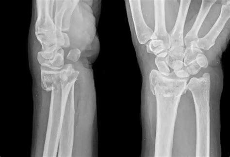Image result for Simple Radius Fracture