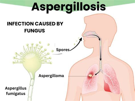 what is Aspergillosis know about harmful impact of this disease on ...