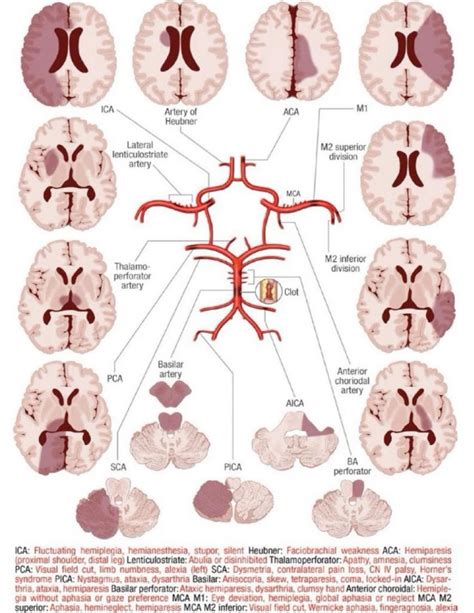 Subdural vs epidural hematoma ct findings location symptoms and pathophysiology – Artofit