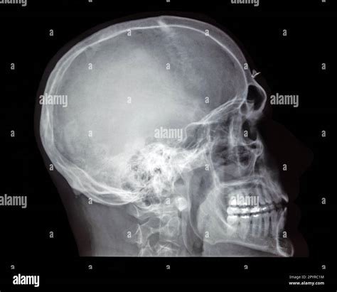 Lateral Skull Sid at Evelyn Lawson blog
