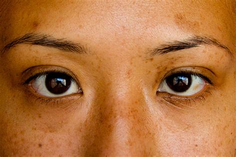 Strabismus Treatment | Cohlmia Eye Center | Wichita