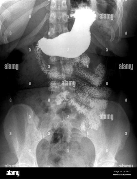 Oeso-gastrointestinal duodenal transit. Frontal X-ray of the digestive ...