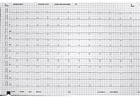 Image result for Telemetry Practice
