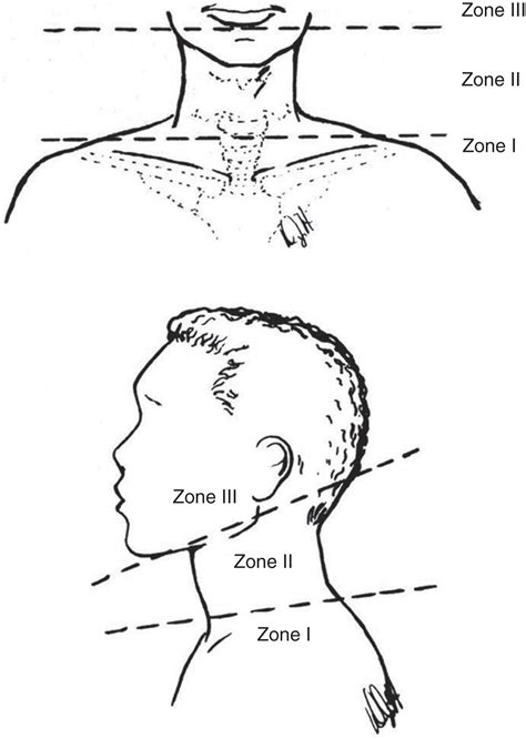 Penetrating neck injuries - Clinical Tree