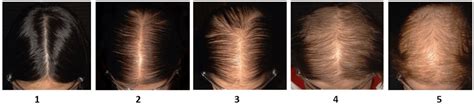 Vitamin D Supplements Improve Hair Regrowth in patients with Diffuse ...