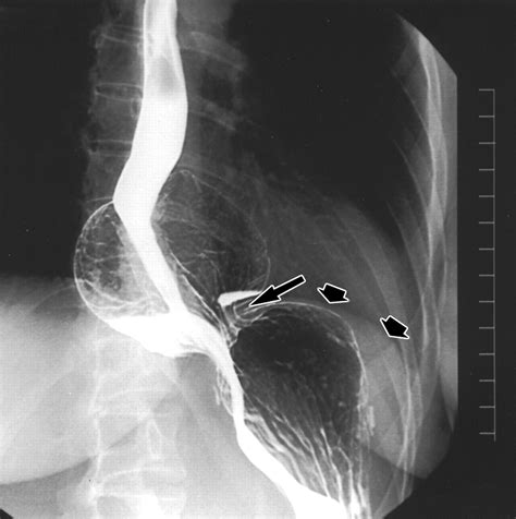 Nissen Fundoplication