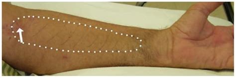 A Retrospective Study of Lateral Antebrachial Cutaneous Nerve ...