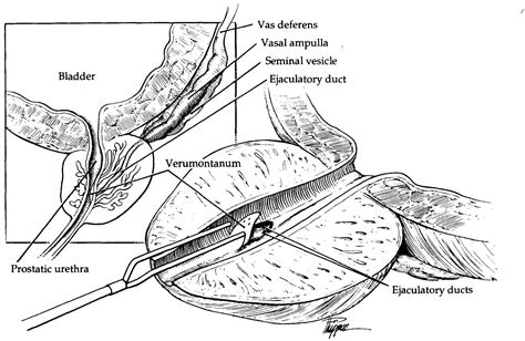 Transurethral resection of the ejaculatory ducts: etiology of ...