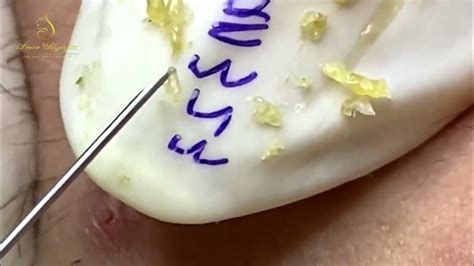 Image result for Worst Exploding Pimple