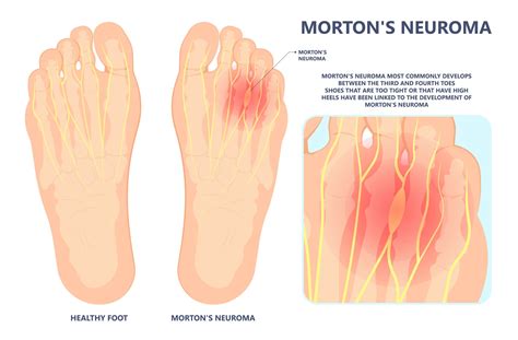 10 Signs You May Have Morton's Neuroma | Podiatry Treatment