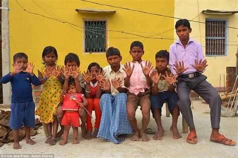 Bihar: Meet the family that has 25 members with 12 fingers and 12 toes each