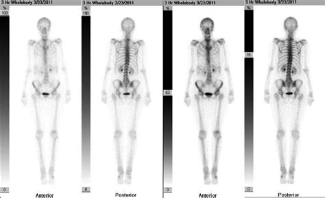 Image result for Normal Bone Scan
