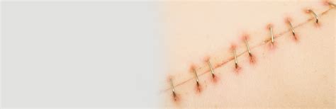 How to Heal stitches Faster?