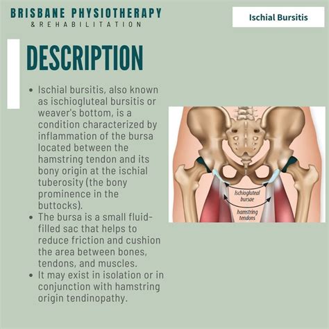 Ischial Bursitis - What is it? Symptoms, Treatment & Physio - Brisbane Physiotherapy & Podiatry