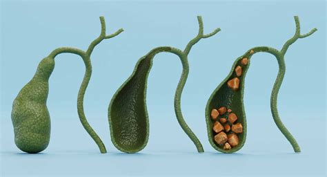 Gallbladder Problems 的图像结果