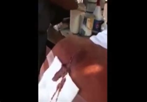 Image result for Explosive Back Cysts