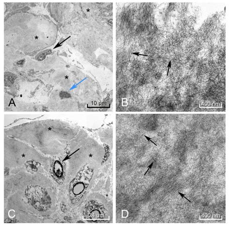 Negative Fat Pad Biopsy in Systemic AL: A Case Report Analyzing the ...