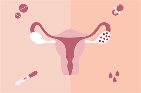 Dealing With PCOD 101 | Grazia India