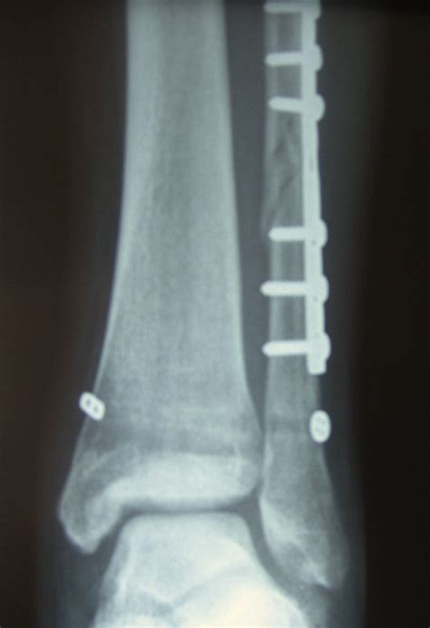 Tightrope fixation of ankle syndesmosis injuries: Clinical outcome ...