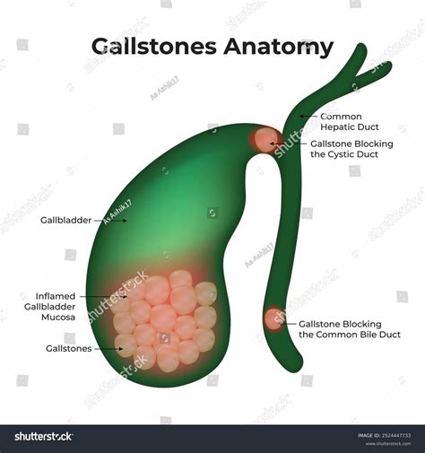 Photos Of Gallstones