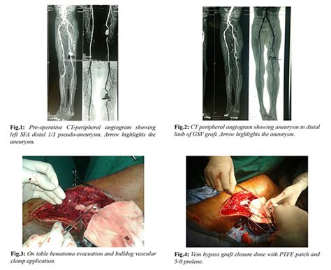 Femoropopliteal Bypass Surgery: Great Saphenous Vein Graft Rupture