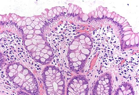 Image result for Polyp Detection Device