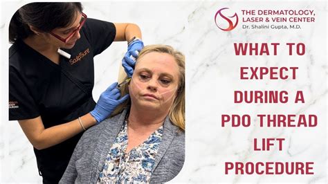 Image result for Cheek Threads