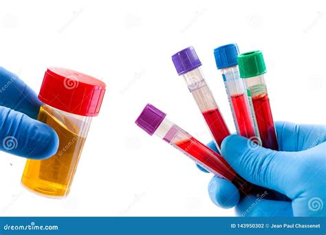 Wbc In Urine Sample