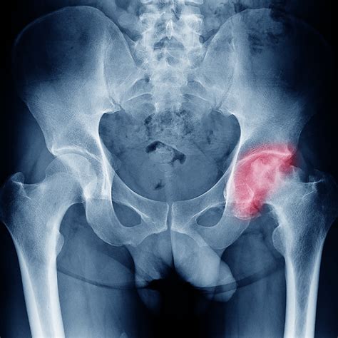 Bombay Orthopaedic Society - Official website of Bombay Orthopaedic Society