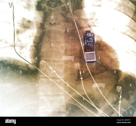 Cardiac monitor implant. Coloured X-ray of a section through the chest ...