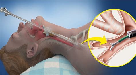 Image result for pouchoscopy