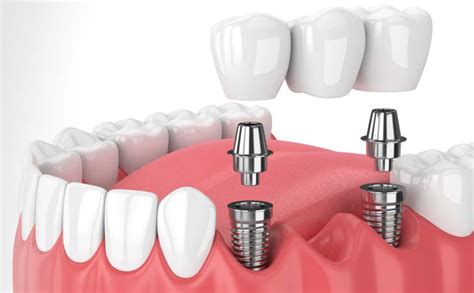 Dental Implants in Whitefield-Dental Implants Surgery