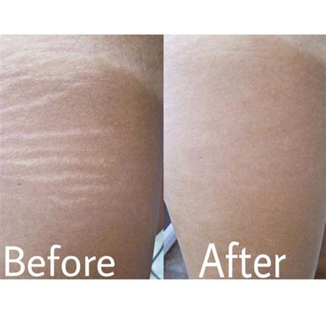 Learn Inkless Stretch Mark Removal : Sydney Cosmetic Tattoo Trainers
