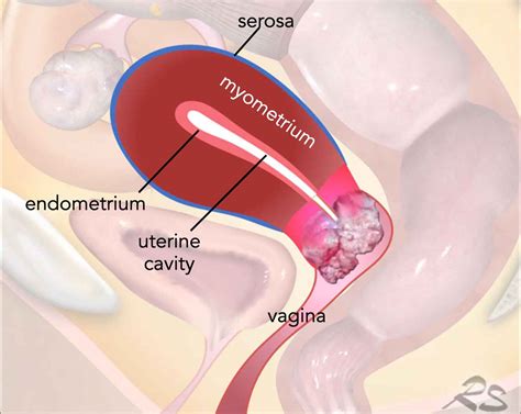 Cervix Cancer Staging