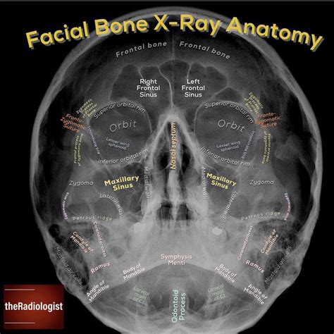 Facial Bones Radiopaedia at Adam Ross blog