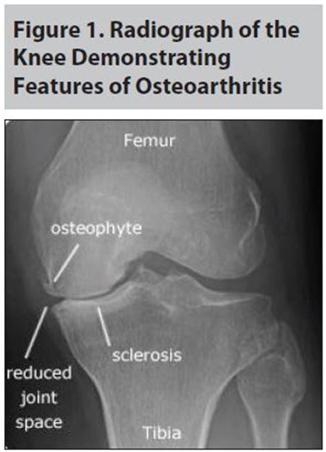 Osteoarthritis | 2015-05-07 | AHC Media: Continuing Medical Education ...