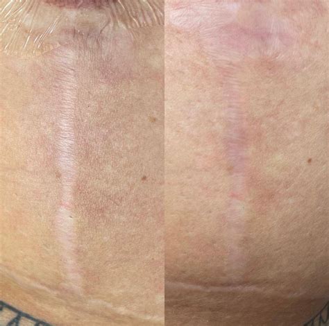 Scar Revision - Chloe's Beauty & Skin Clinic