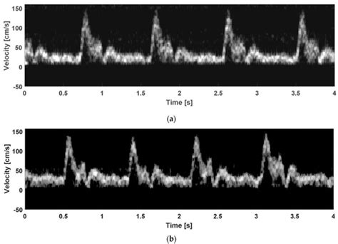 Design and Implementation of a New Wireless Carotid Neckband Doppler ...