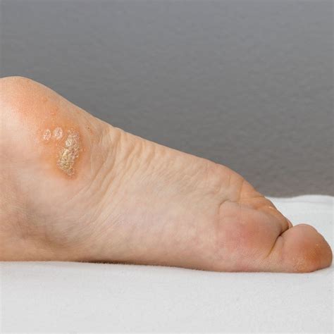 Plantar Warts 101: The Lowdown on Those Sneaky Foot Invaders – Forces of Nature Medicine