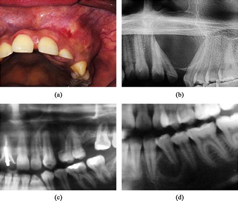 An international collaborative study of 105 new cases of adenomatoid odontogenic tumors - Oral ...