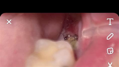 Image result for Back Molar Tooth Extraction