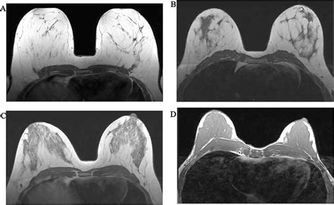 Background parenchymal enhancement and fibroglandular tissue on breast MRI in women with high ...