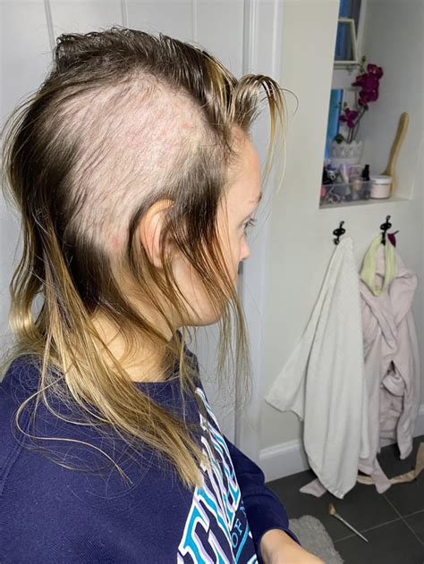 Image result for Diffuse Alopecia