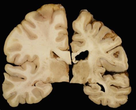 Image result for Brain Tissue Sample