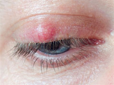 Styes: causes, symptoms & treatments | Specsavers Australia