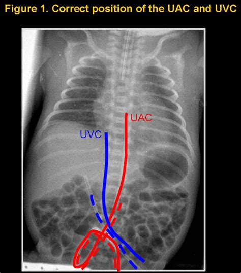 Figure 18 from Umbilical catheters: location and complications ...