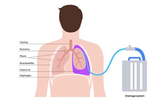 A Basic Guide to Chest Tube by KTPH_YCH - Issuu