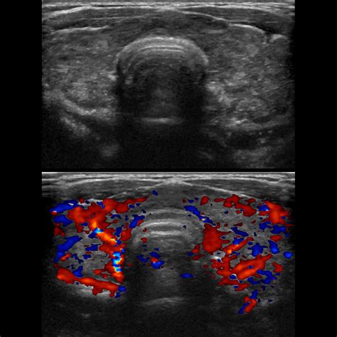 Hashimotos Thyroiditis Ultrasound