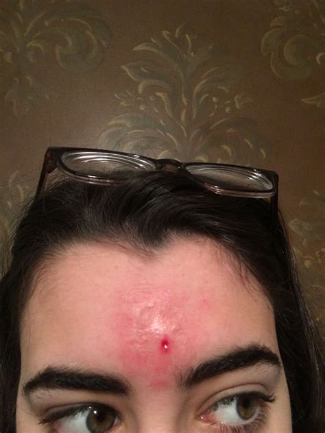 Whats going on with my forehead? - General acne discussion - Acne.org