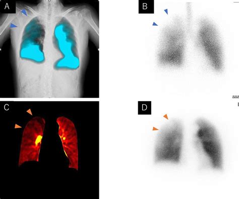 Case of hot tub lung showing a shadow distribution consistent with ...